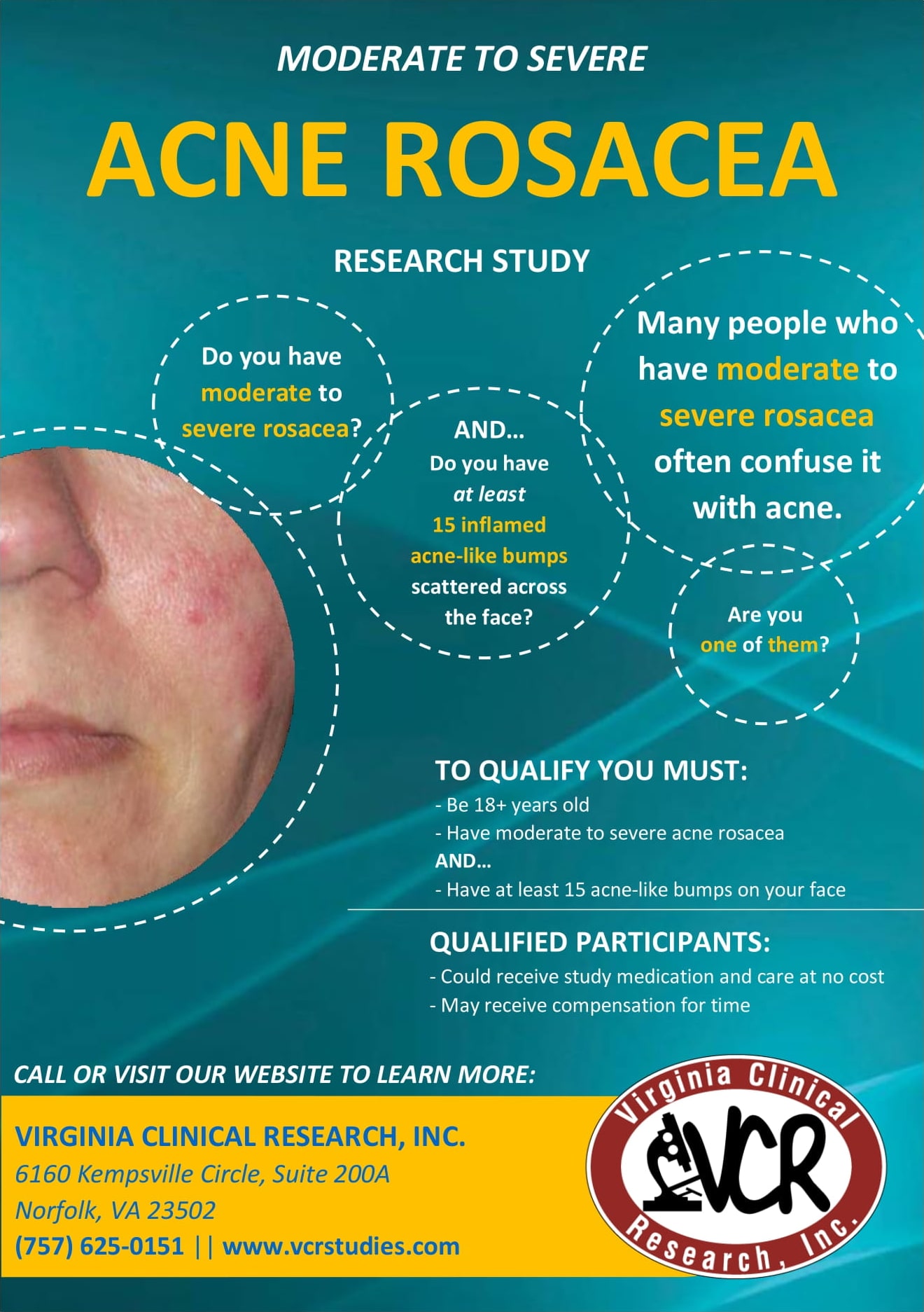 Moderate to Severe Acne Rosacea AD